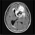 Épendymome du ventricule latéral