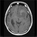 Épendymome du ventricule latéral