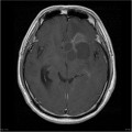 Épendymome du ventricule latéral