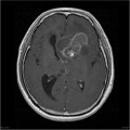 Épendymome du ventricule latéral