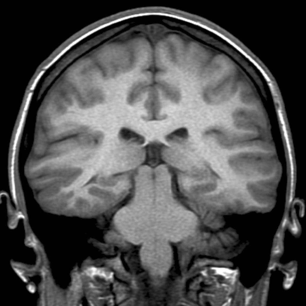 Dysplasie corticale focale temporale droite