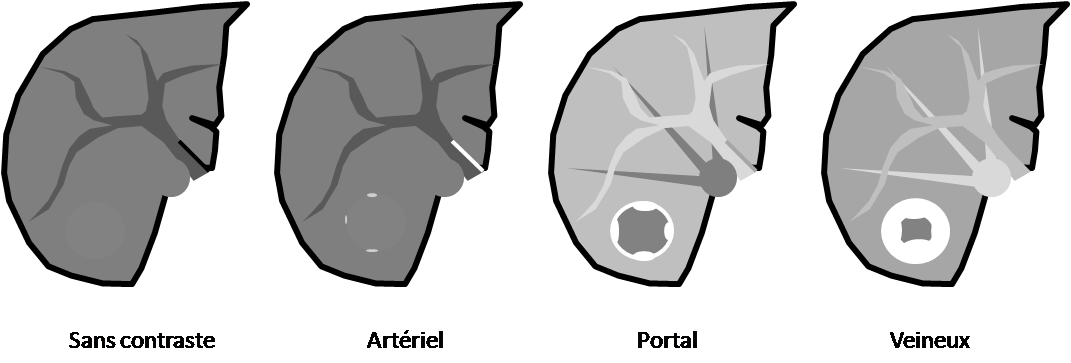 Tumeurs hépatiques – Angiome hépatique – PinkyBone