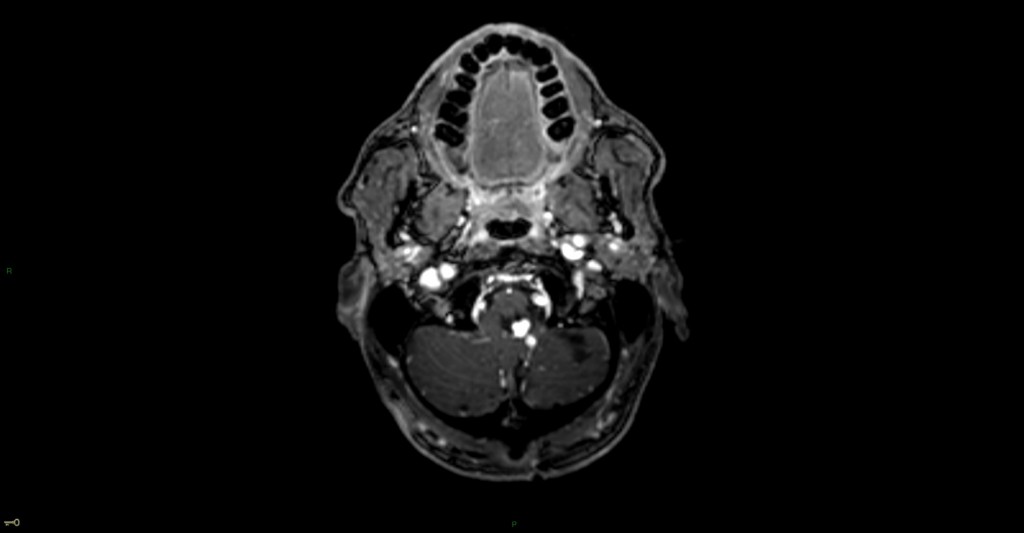 Hémangioblastome dans le cadre d'une maladie de Von Hippel Lindau