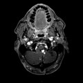 Hémangioblastome dans le cadre d'une maladie de Von Hippel Lindau