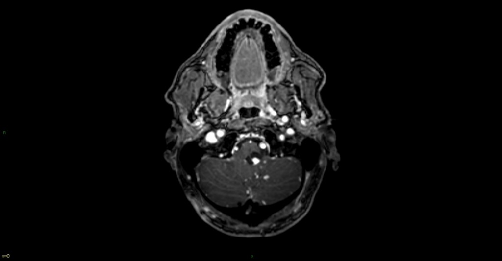 Hémangioblastome dans le cadre d'une maladie de Von Hippel Lindau