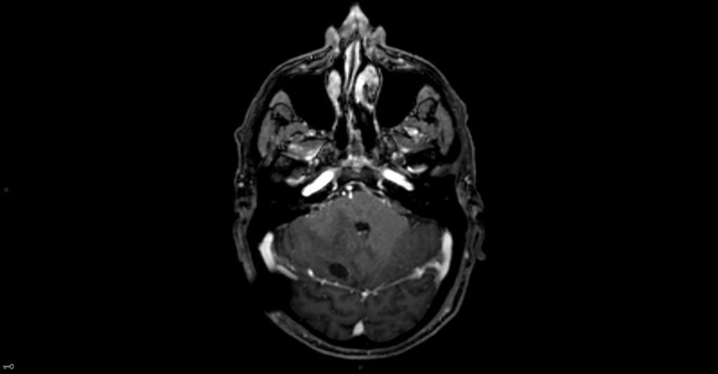 Hémangioblastome dans le cadre d'une maladie de Von Hippel Lindau