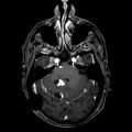 Hémangioblastome dans le cadre d'une maladie de Von Hippel Lindau