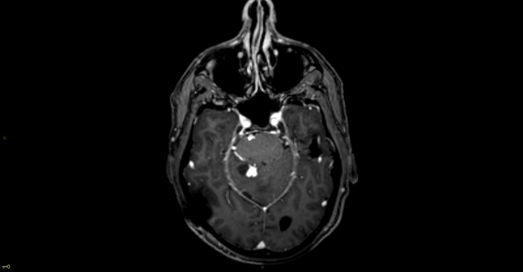 Hémangioblastome dans le cadre d'une maladie de Von Hippel Lindau