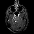 Hémangioblastome dans le cadre d'une maladie de Von Hippel Lindau