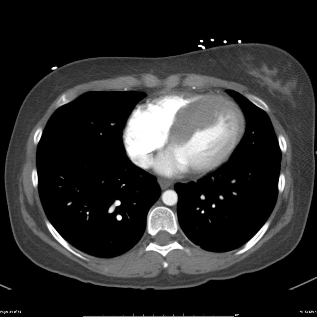 Cardiomyopathie hypertrophique (CMH)