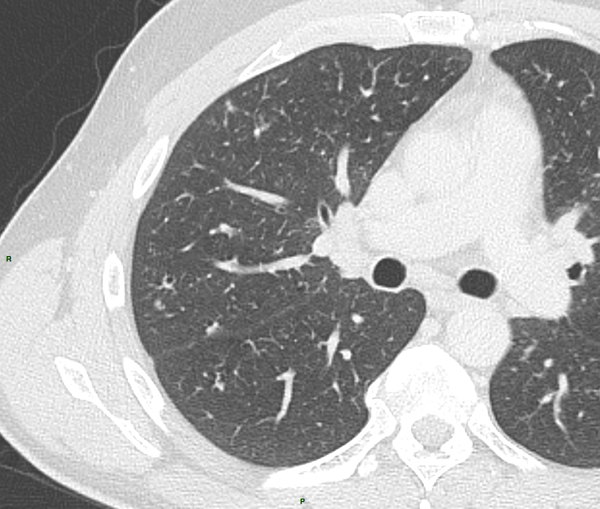 HISTIOCYTOSE X