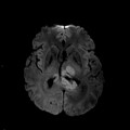 Localisation cérébrale d'un lymphome B à grandes cellules diffus, EBV négatif