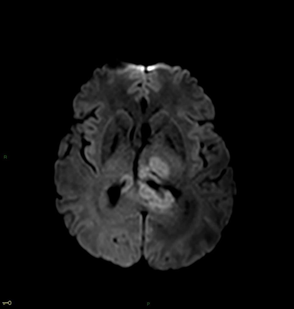 Localisation cérébrale d'un lymphome B à grandes cellules diffus, EBV négatif