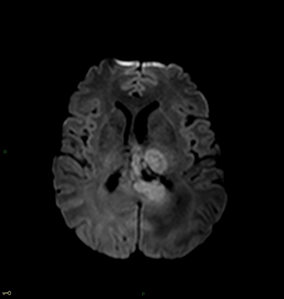 Localisation cérébrale d'un lymphome B à grandes cellules diffus, EBV négatif