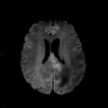 Localisation cérébrale d'un lymphome B à grandes cellules diffus, EBV négatif