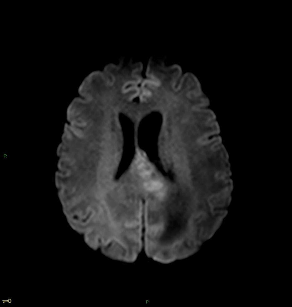 Localisation cérébrale d'un lymphome B à grandes cellules diffus, EBV négatif