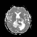 Localisation cérébrale d'un lymphome B à grandes cellules diffus, EBV négatif