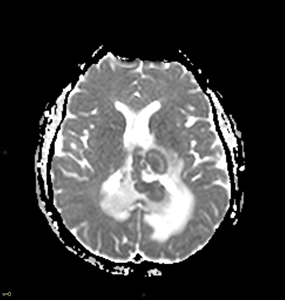 Localisation cérébrale d'un lymphome B à grandes cellules diffus, EBV négatif