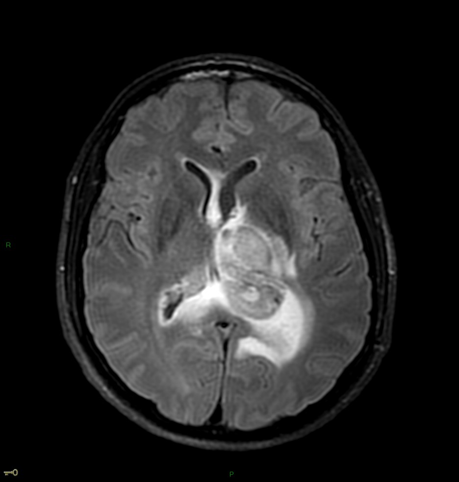 Localisation cérébrale d'un lymphome B à grandes cellules diffus, EBV négatif