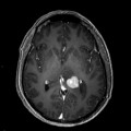 Localisation cérébrale d'un lymphome B à grandes cellules diffus, EBV négatif