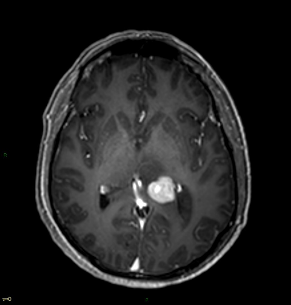 Localisation cérébrale d'un lymphome B à grandes cellules diffus, EBV négatif