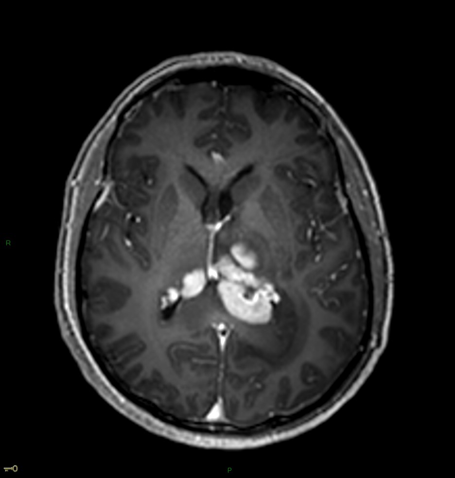 Localisation cérébrale d'un lymphome B à grandes cellules diffus, EBV négatif