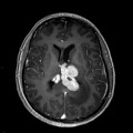 Localisation cérébrale d'un lymphome B à grandes cellules diffus, EBV négatif