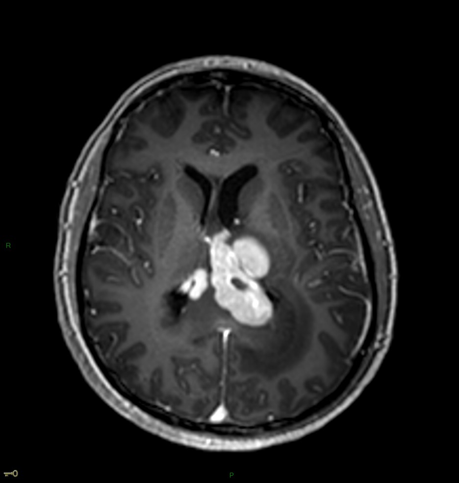 Localisation cérébrale d'un lymphome B à grandes cellules diffus, EBV négatif