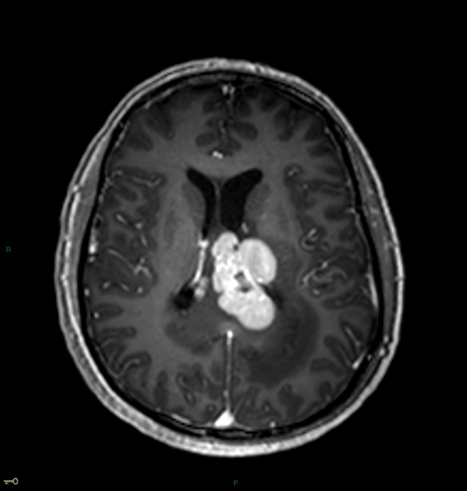 Localisation cérébrale d'un lymphome B à grandes cellules diffus, EBV négatif