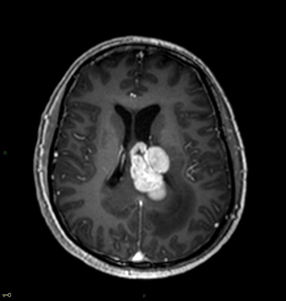 Localisation cérébrale d'un lymphome B à grandes cellules diffus, EBV négatif