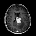 Localisation cérébrale d'un lymphome B à grandes cellules diffus, EBV négatif