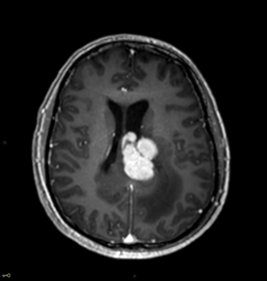 Localisation cérébrale d'un lymphome B à grandes cellules diffus, EBV négatif