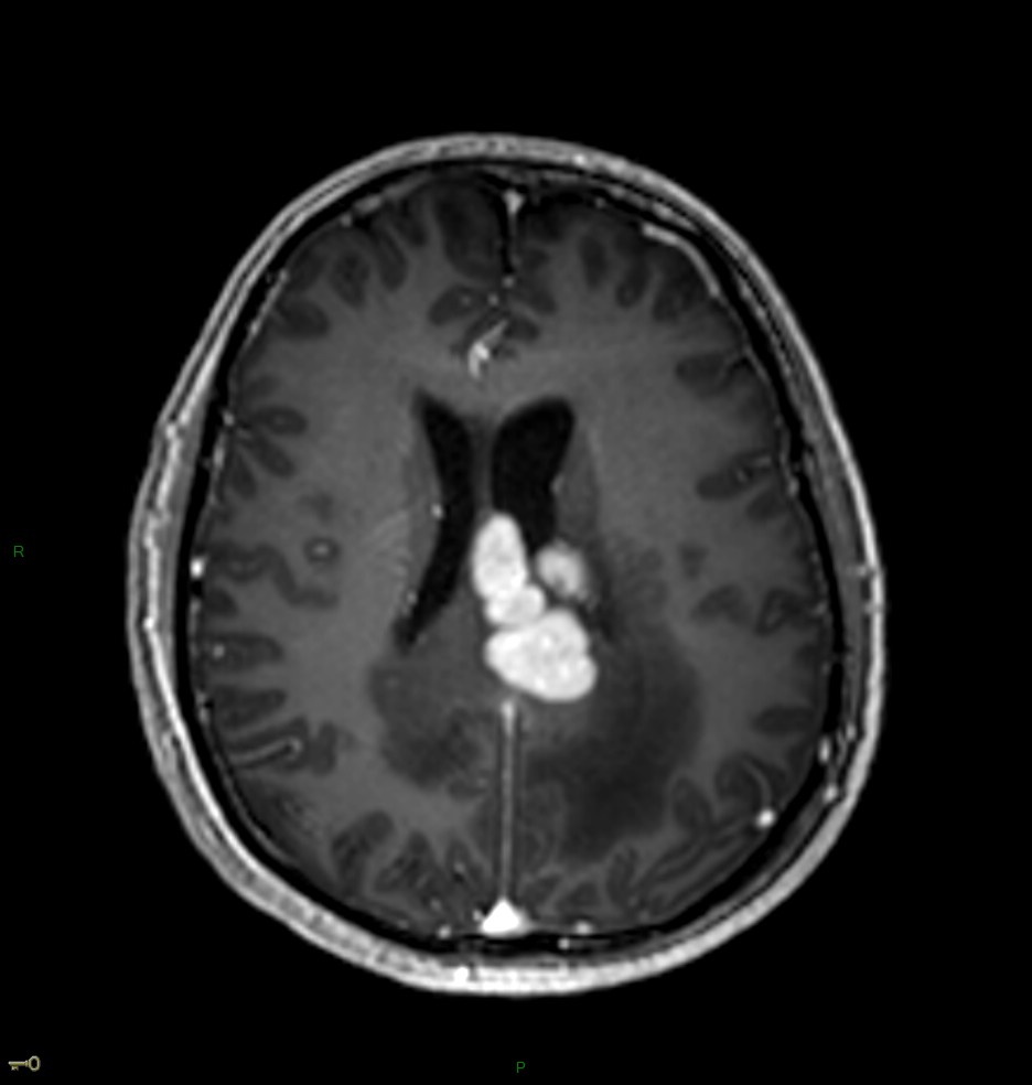 Localisation cérébrale d'un lymphome B à grandes cellules diffus, EBV négatif