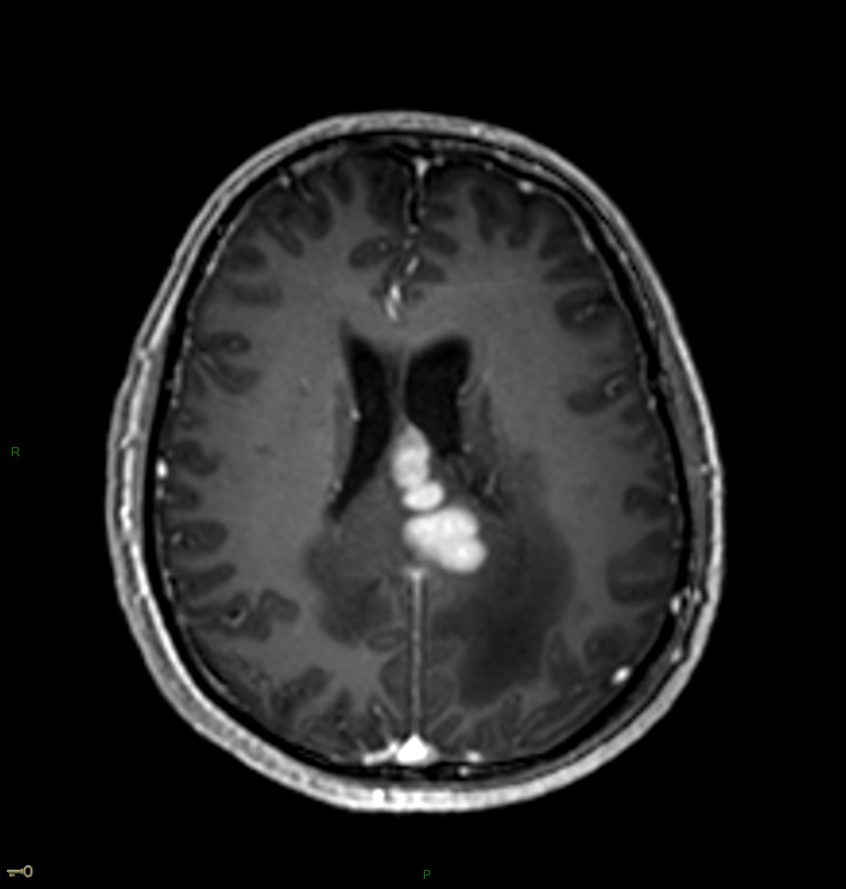 Localisation cérébrale d'un lymphome B à grandes cellules diffus, EBV négatif