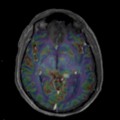 Localisation cérébrale d'un lymphome B à grandes cellules diffus, EBV négatif