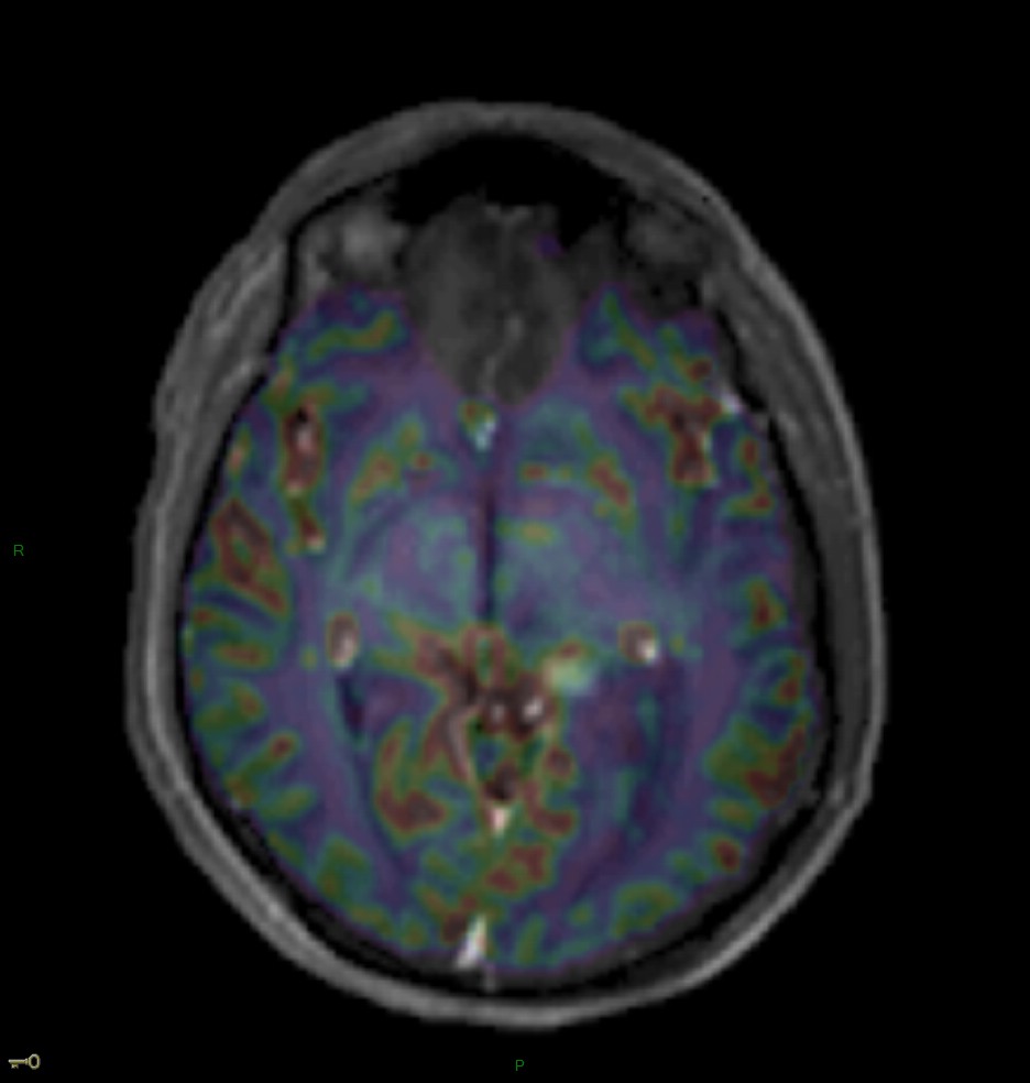 Localisation cérébrale d'un lymphome B à grandes cellules diffus, EBV négatif