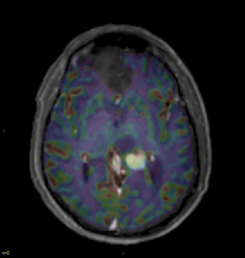 Localisation cérébrale d'un lymphome B à grandes cellules diffus, EBV négatif