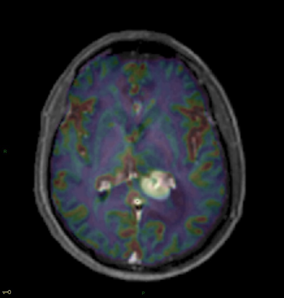 Localisation cérébrale d'un lymphome B à grandes cellules diffus, EBV négatif