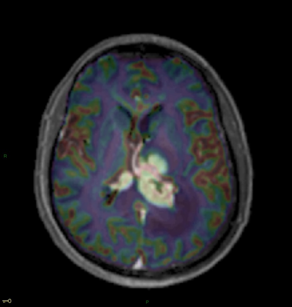 Localisation cérébrale d'un lymphome B à grandes cellules diffus, EBV négatif