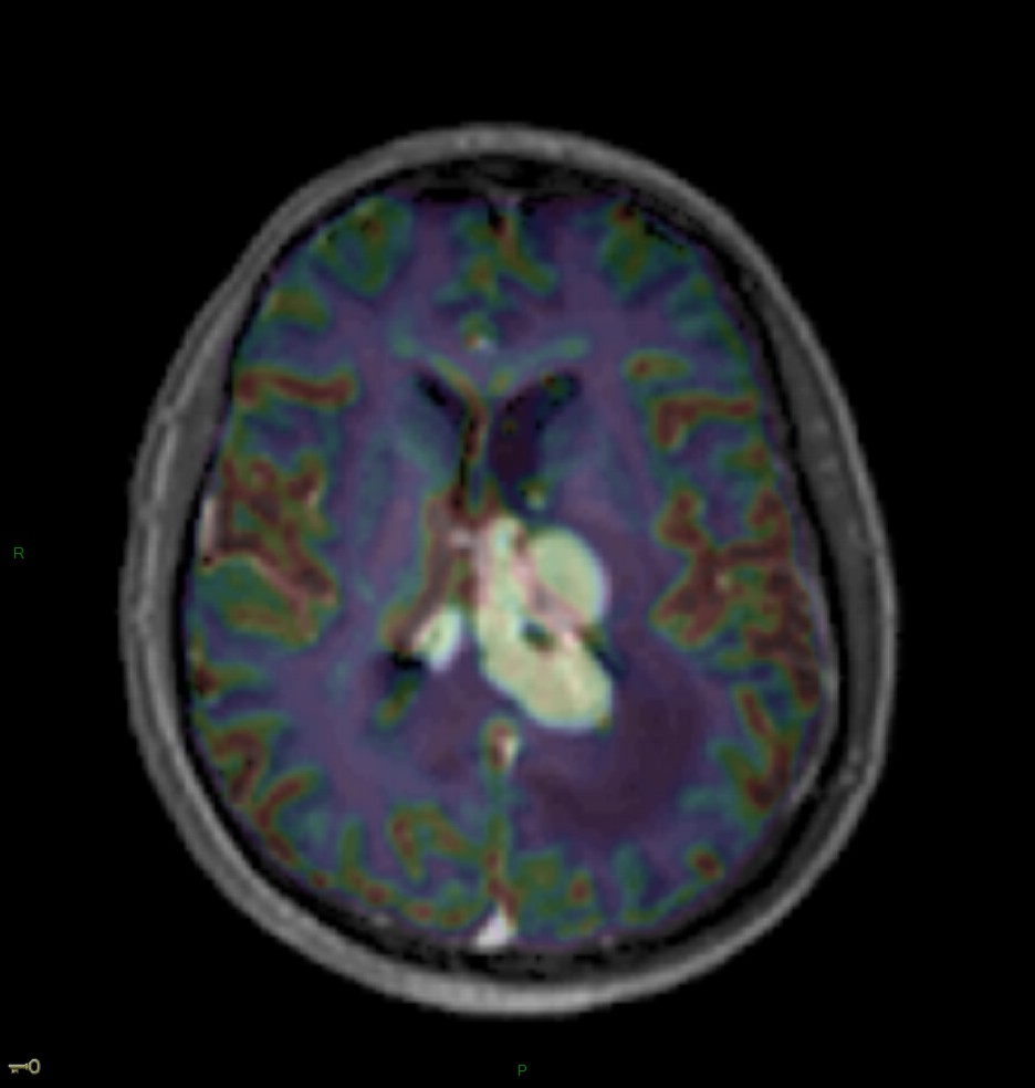 Localisation cérébrale d'un lymphome B à grandes cellules diffus, EBV négatif