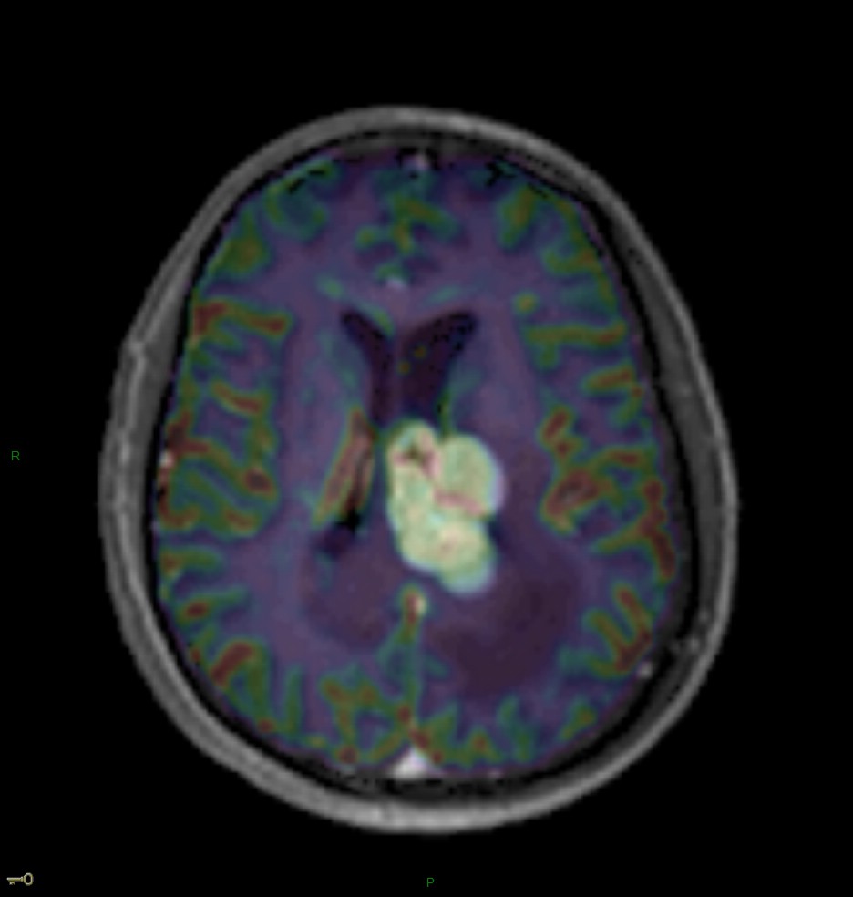 Localisation cérébrale d'un lymphome B à grandes cellules diffus, EBV négatif