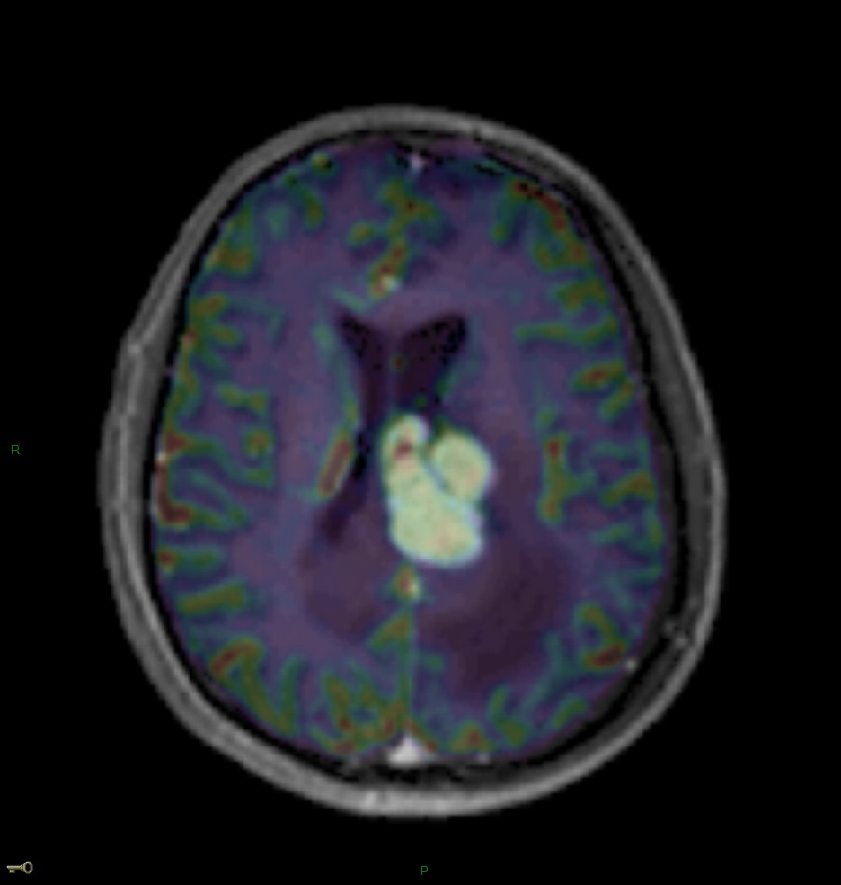 Localisation cérébrale d'un lymphome B à grandes cellules diffus, EBV négatif