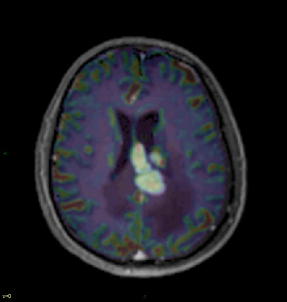 Localisation cérébrale d'un lymphome B à grandes cellules diffus, EBV négatif