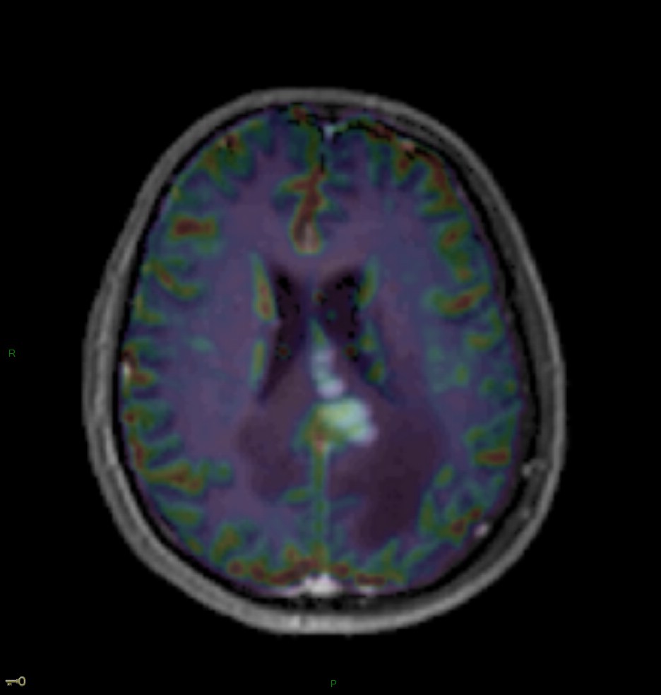 Localisation cérébrale d'un lymphome B à grandes cellules diffus, EBV négatif