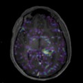 Localisation cérébrale d'un lymphome B à grandes cellules diffus, EBV négatif