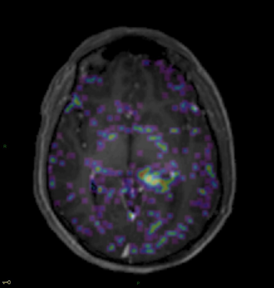 Localisation cérébrale d'un lymphome B à grandes cellules diffus, EBV négatif