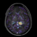 Localisation cérébrale d'un lymphome B à grandes cellules diffus, EBV négatif