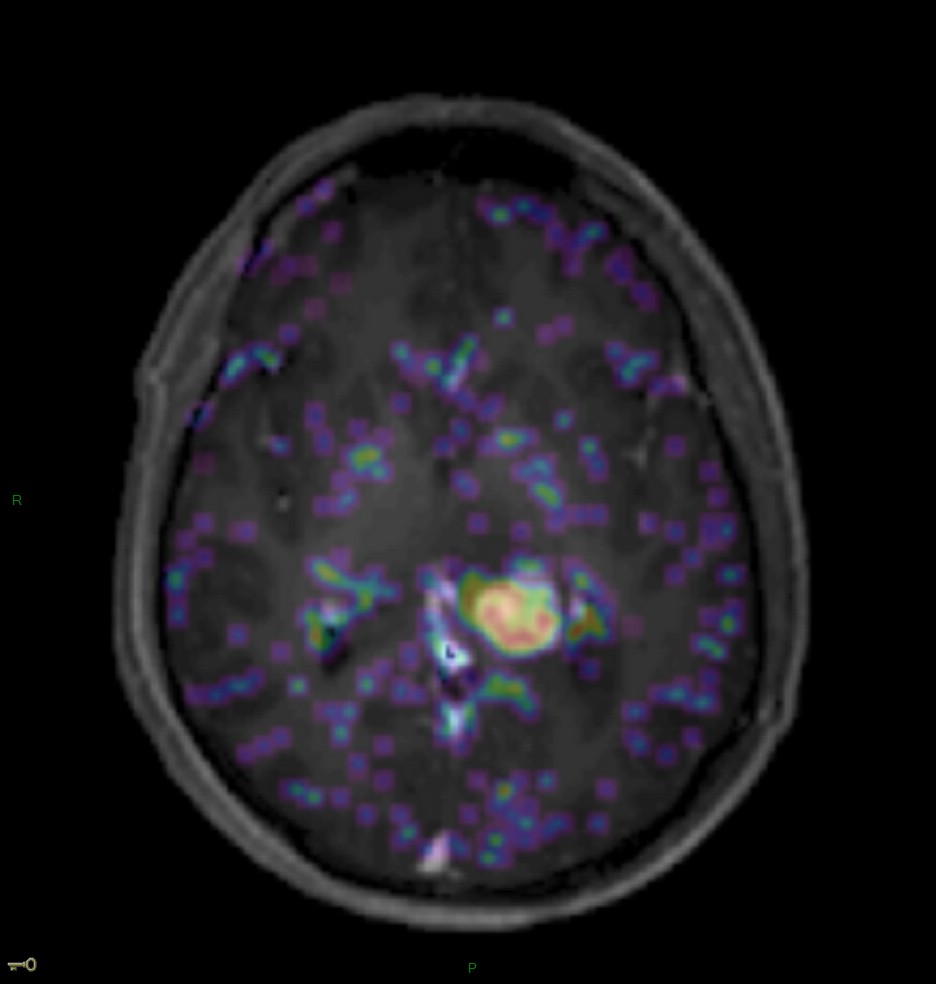 Localisation cérébrale d'un lymphome B à grandes cellules diffus, EBV négatif