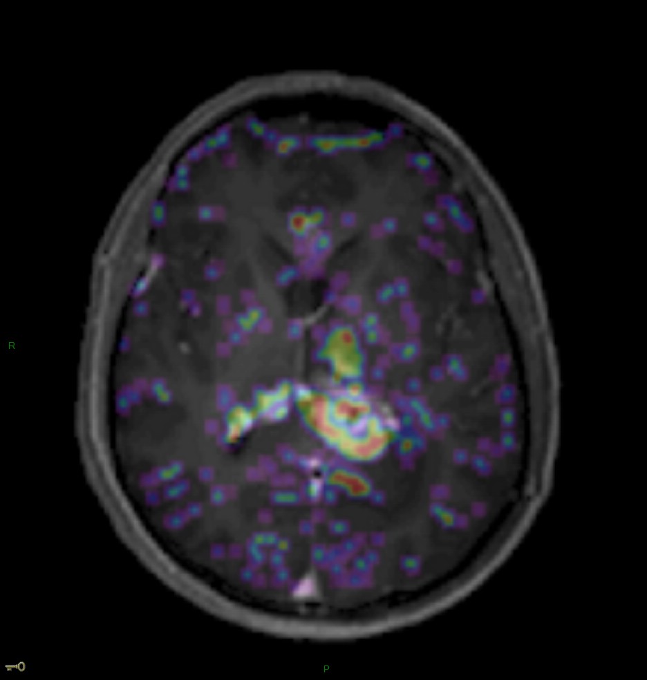 Localisation cérébrale d'un lymphome B à grandes cellules diffus, EBV négatif