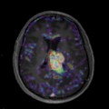 Localisation cérébrale d'un lymphome B à grandes cellules diffus, EBV négatif